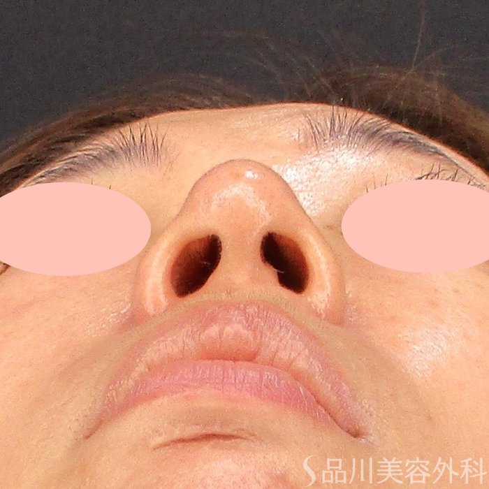 症例NO.70276のAFTER写真