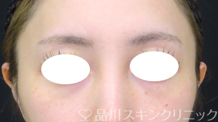 症例NO.62718のAFTER写真