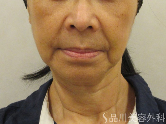 症例NO.74787のBEFORE写真