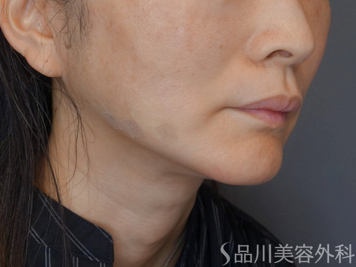 症例NO.72079のAFTER写真