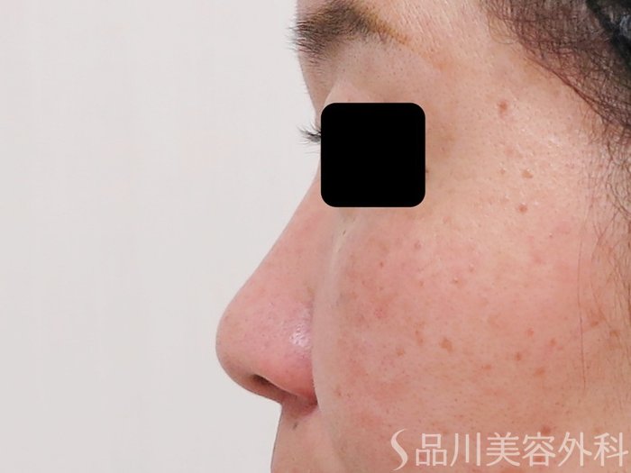 症例NO.69541のBEFORE写真