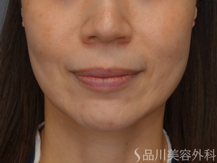 症例NO.67848のBEFORE写真