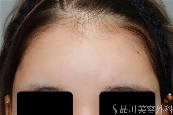 症例NO.50590のBEFORE写真