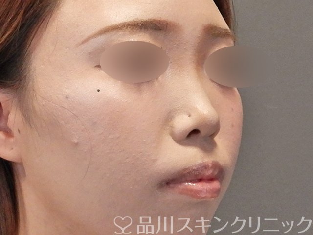 症例NO.75251のBEFORE写真