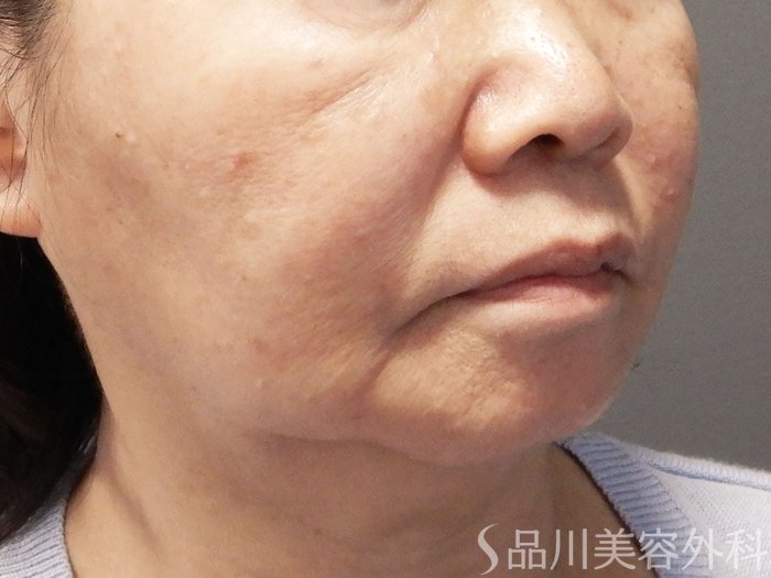 症例NO.72163のAFTER写真