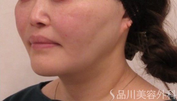 症例NO.75167のBEFORE写真