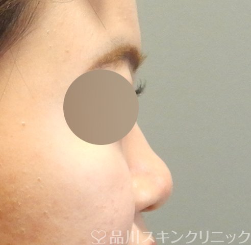 症例NO.62986のBEFORE写真