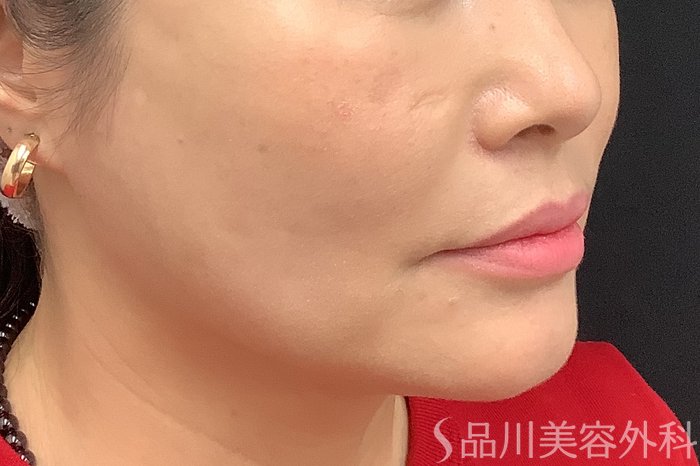 症例NO.73320のAFTER写真