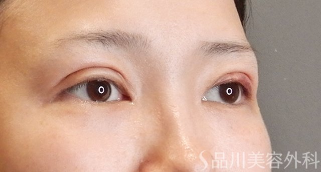 症例NO.75158のAFTER写真