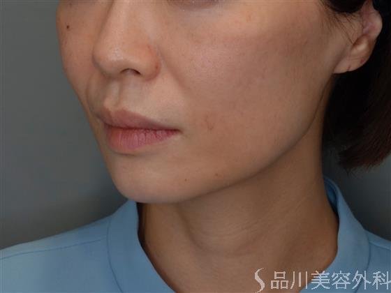 症例NO.51087のBEFORE写真