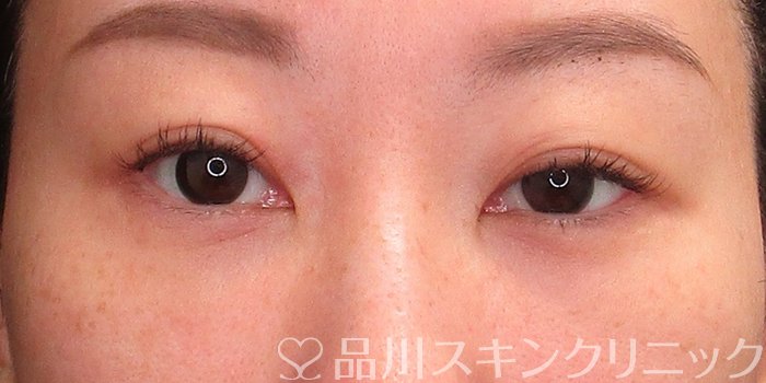 症例NO.73465のAFTER写真