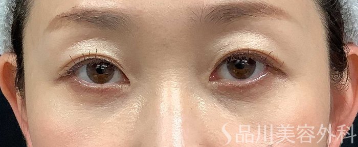 症例NO.71034のAFTER写真