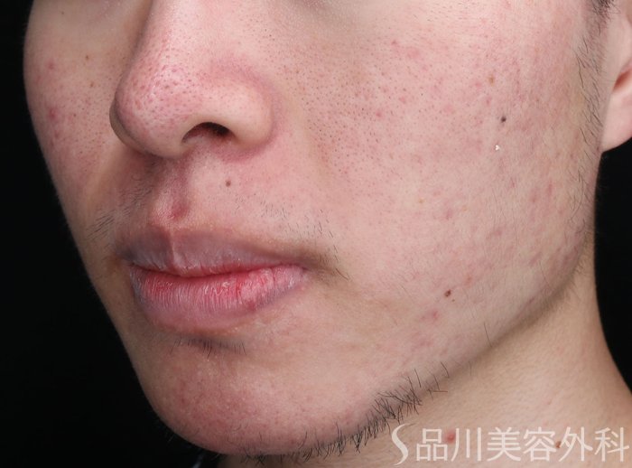 症例NO.73536のAFTER写真