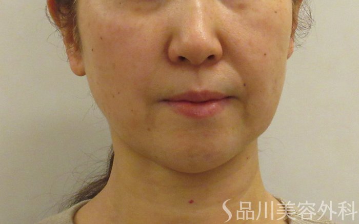 症例NO.73231のBEFORE写真