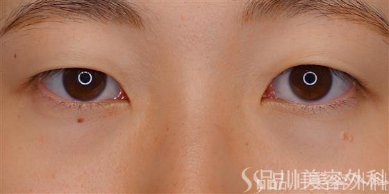 症例NO.72321のBEFORE写真