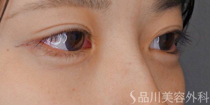 症例NO.71324のAFTER写真
