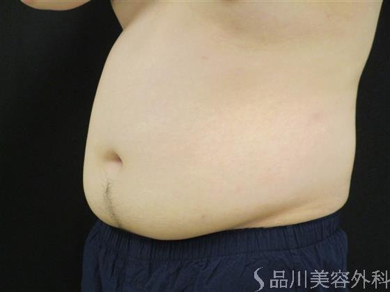 症例NO.51291のBEFORE写真