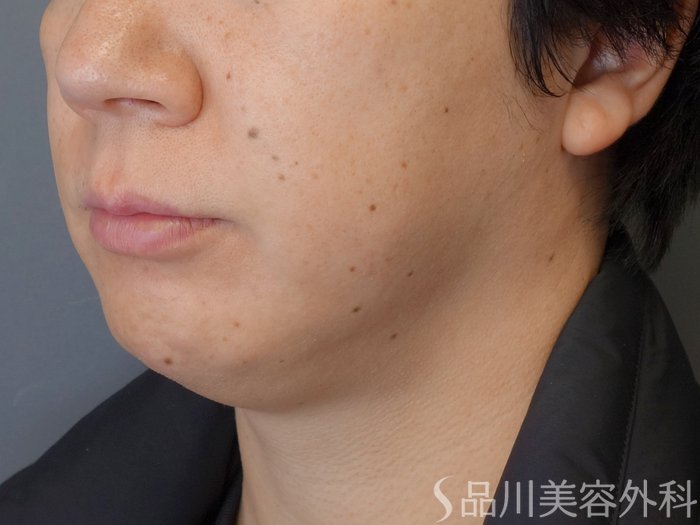 症例NO.72965のBEFORE写真