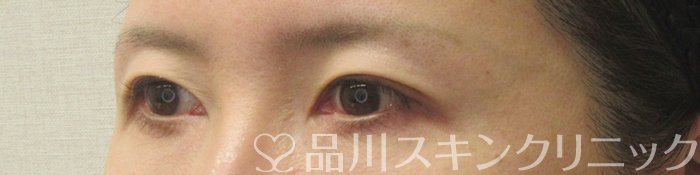 症例NO.71138のBEFORE写真