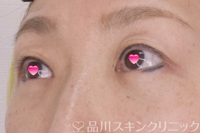 症例NO.69526のAFTER写真