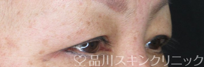 症例NO.65678のBEFORE写真