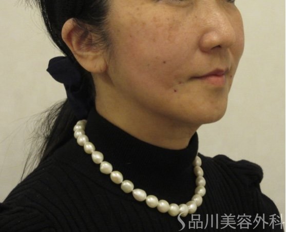 症例NO.72548のAFTER写真