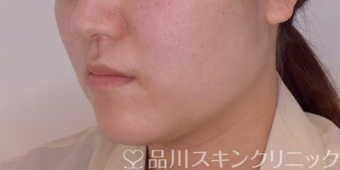 症例NO.68070のBEFORE写真