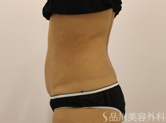 症例NO.72109のAFTER写真