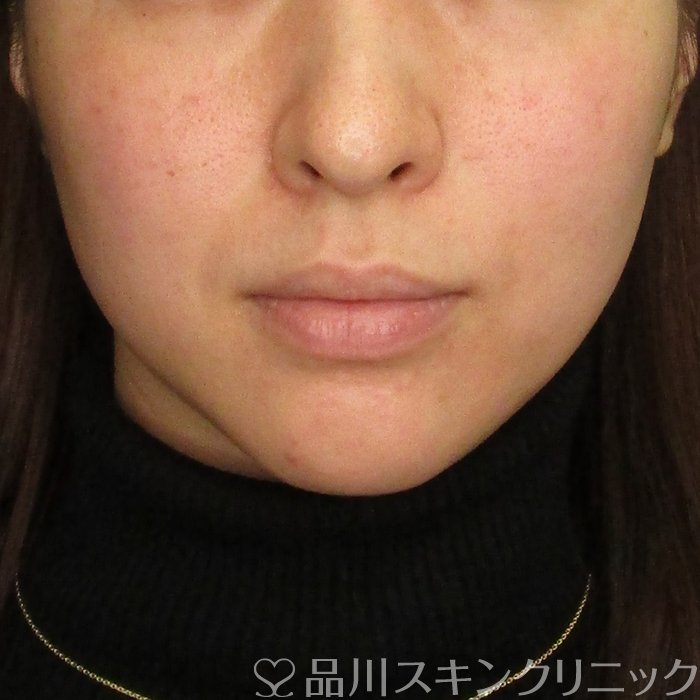 症例NO.70140のBEFORE写真