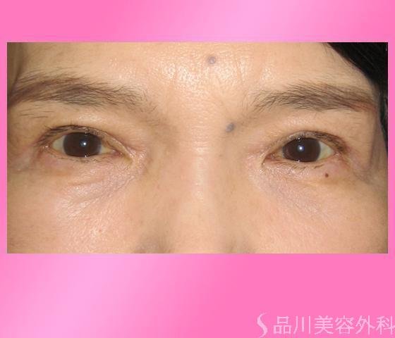 症例NO.1739のAFTER写真