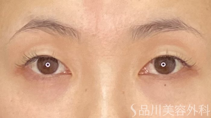 症例NO.71146のBEFORE写真