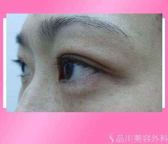 症例NO.13172のBEFORE写真