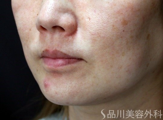 症例NO.69921のBEFORE写真