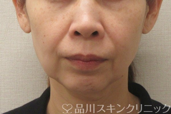 症例NO.74830のBEFORE写真