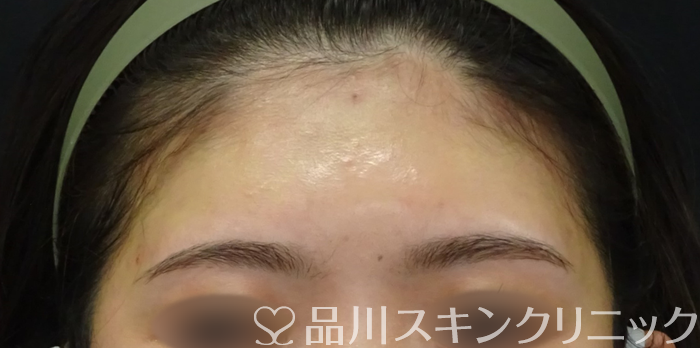 症例NO.69405のAFTER写真