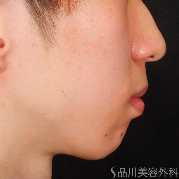 症例NO.68025のBEFORE写真