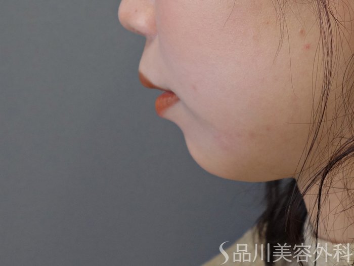 症例NO.72579のBEFORE写真