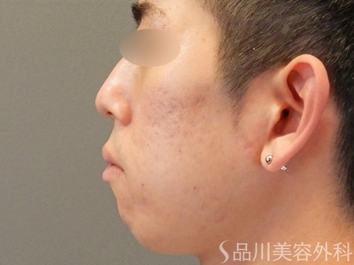 症例NO.67922のAFTER写真