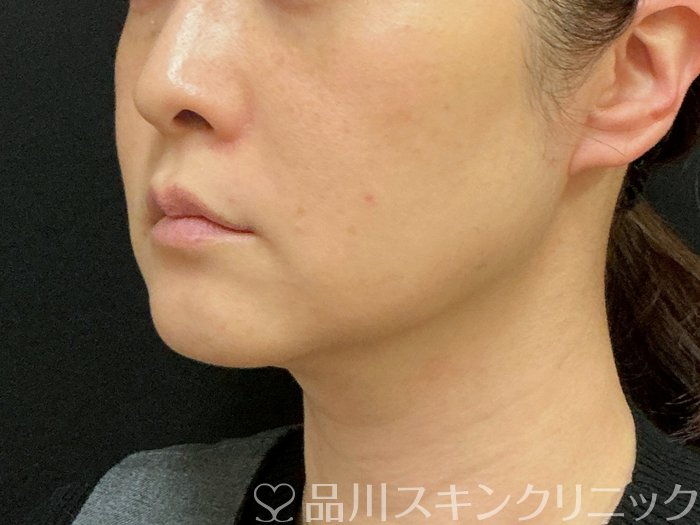 症例NO.74300のBEFORE写真