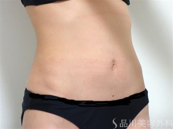 症例NO.27595のBEFORE写真
