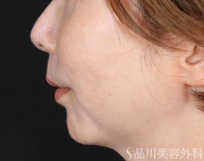 症例NO.71863のAFTER写真