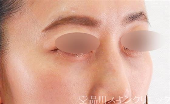 症例NO.60525のAFTER写真