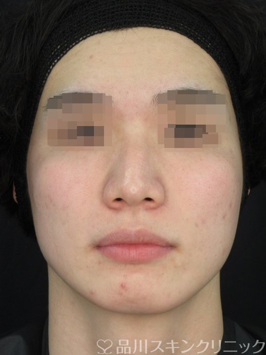 症例NO.73417のAFTER写真