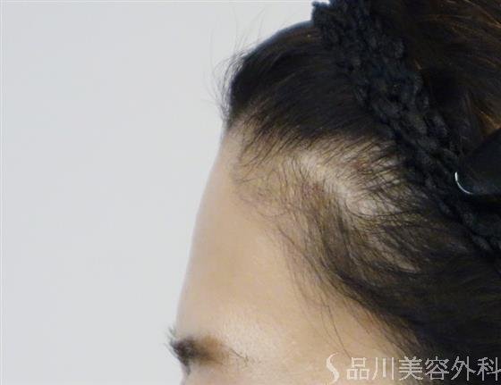 症例NO.48424のBEFORE写真