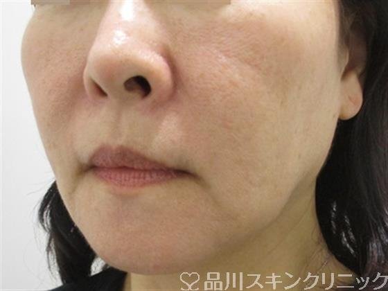 症例NO.37931のBEFORE写真