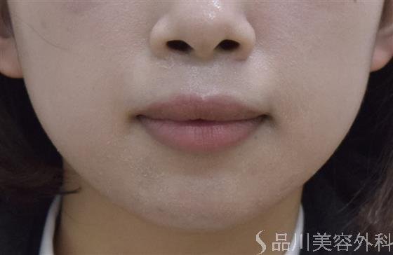 症例NO.46844のBEFORE写真