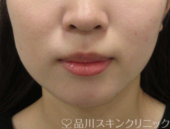 症例NO.70480のBEFORE写真