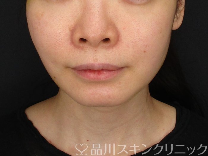 症例NO.70240のAFTER写真