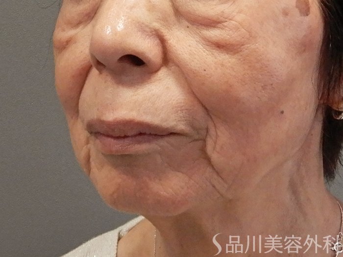 症例NO.70287のBEFORE写真