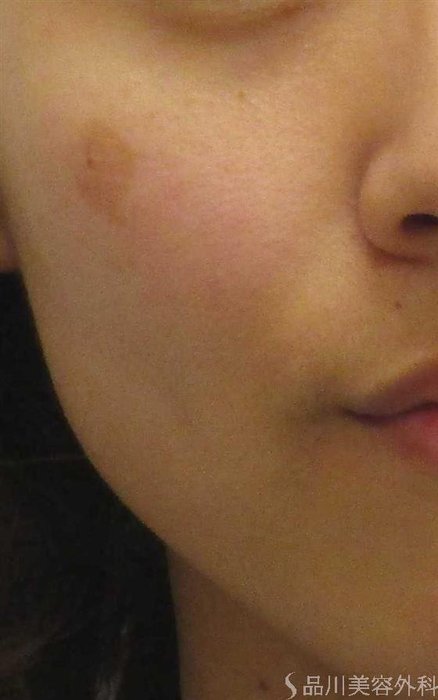 症例NO.56351のBEFORE写真